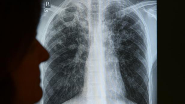 5 Fragen zu Tuberkulose