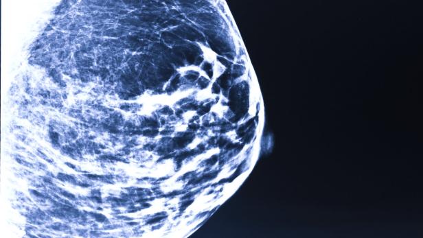 Mammografie: Wer diese Untersuchung regelmäßig im Rahmen eines qualitätsgesicherten Programms durchführen lässt, verringert dadurch laut internationalen Studien sein Risiko, an Brustkrebs zu sterben.
