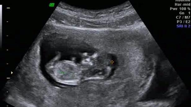 Ein Ultraschallbild zeigt ein ungeborenes Kind im Mutterleib.