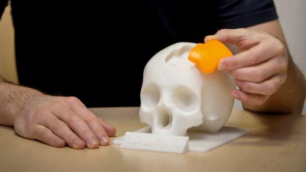 Eine Person setzt ein orangefarbenes Teil in einen 3D-gedruckten Schädel ein.