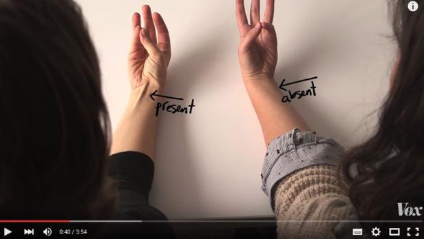 Zwei Frauen demonstrieren das Vorhandensein und Fehlen eines bestimmten Handmuskels.