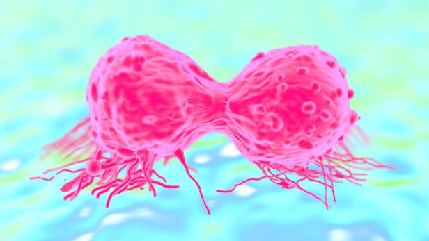Brustkrebszellen: Eine vorbeugende medikamentöse Therapie könnte künftig bei Frauen nach der Menopause mit hohem Brustkrebsrisiko durchgeführt werden