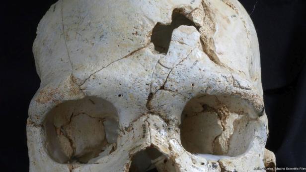 Nahaufnahme eines beschädigten menschlichen Schädels.