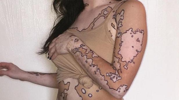 Eine Frau macht aus ihrer Hautkrankheit eine Landkarte