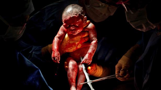 Fotoserie zeigt Babys Sekunden nach dem Kaiserschnitt