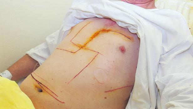 Im Februar hatte der 52-Jährige ein Hakenkreuz in die Brust geritzt