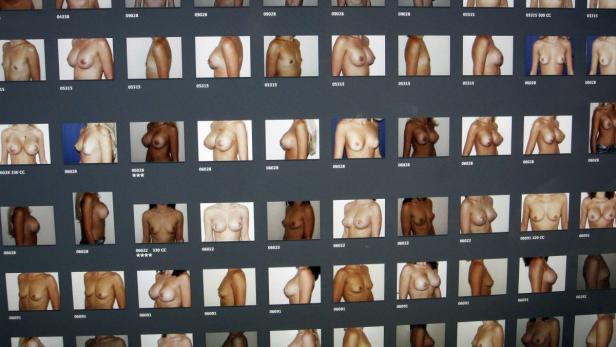 The torsos of patients with breast implants are seen on a computer screen in a clinic in Nice in this December 26, 2011, file photo. Health authorities might like to put the French PIP breast implant scandal sweeping Europe down to a rogue entrepreneur determined to cash in by duping inspectors and thwarting regulations, but with 500,000 medical technologies in Europe - from sticking plasters and wheel chairs to pacemakers and replacement joints - many of them made by small companies, the scattered and ad hoc system of regulation may be just another scandal waiting to happen. Picture taken December 26, 2011. To match Insight BREAST-IMPLANTS/REGULATION REUTERS/Eric Gaillard/Files (FRANCE - Tags: HEALTH SOCIETY) TEMPLATE OUT