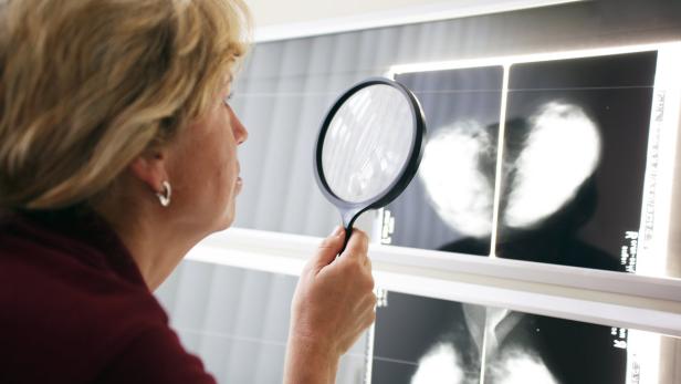 Eine Frau betrachtet Mammographie-Aufnahmen mit einer Lupe.