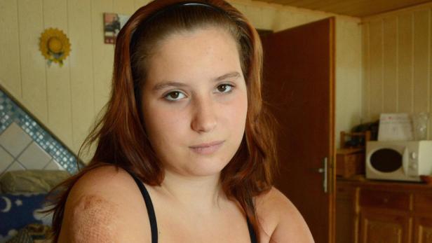 Ramona Monz, 16, leidet unter den Narben am rechten Oberarm.