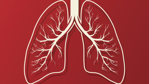 Neue Therapieansätze bei Lungenkrebs helfen noch nicht allen Patienten.