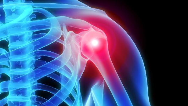 Eine verkalkte Schulter ist mit besonders starken Schmerzen verbunden und sollte daher sofort behandelt werden.