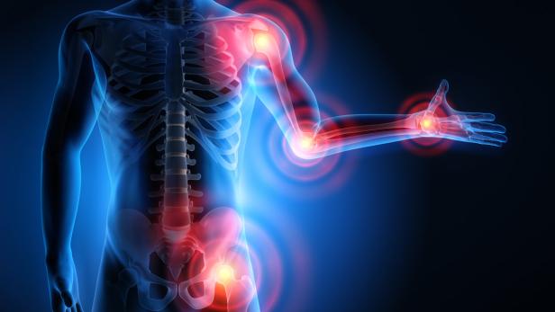 Eine Röntgenaufnahme eines menschlichen Körpers mit hervorgehobenen schmerzenden Gelenken.