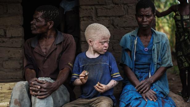 Bis zu 10.000 Menschen in Malawi leben mit mit Albinismus.