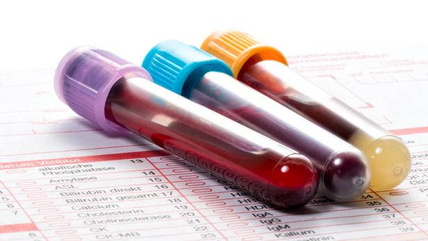 Bluttest soll Krebs früh erkennen