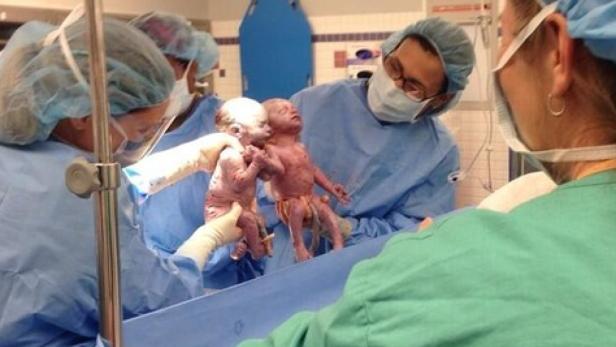 Ärzte halten zwei Neugeborene nach der Geburt im Operationssaal.