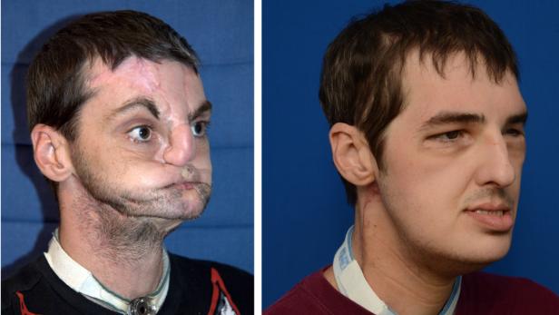 dapdIn photos provided by the University of Maryland Medical Center, face transplant recipient Richard Lee Norris, the recipient of the most extensive face transplant performed to date, is seen a photo taken before the face transplant, left, and in a phot Transplantation: Mann erhält neues Gesicht