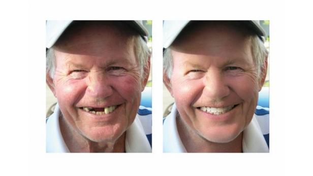 Ein Mann lächelt vor und nach einer Zahnbehandlung.