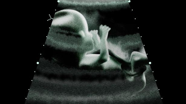 Das Baby wächst in der linken Gebärmutter heran, zeigen Ultraschallbilder (Symbolbild).