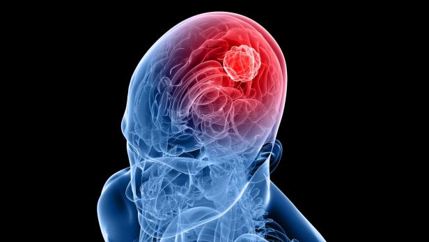 Gehirntumor: Ein Glioblastom ist derzeit noch unheilbar.