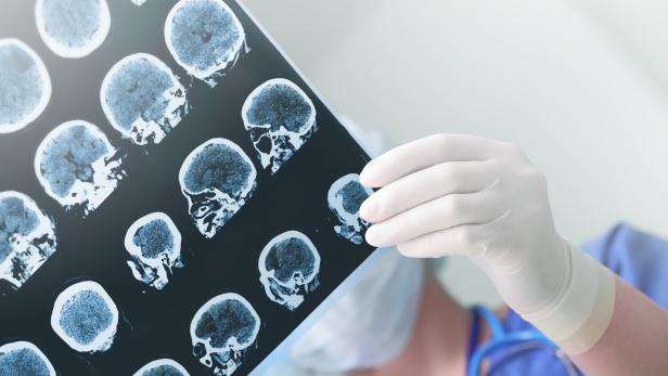 Bei Parkinson sterben Gehirnzellen unwiderruflich ab