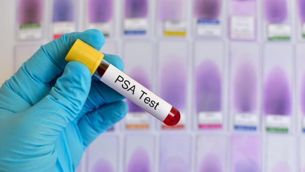 PSA-Test: 4500 Fälle von Prostatakrebs jährlich.
