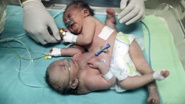 Die siamesischen Zwillinge in Gaza-Stadt einen Tag nach der Geburt.