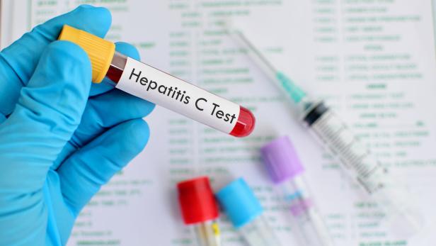 Jedes Jahr sterben 1,3 Millionen Menschen an Hepatitis.