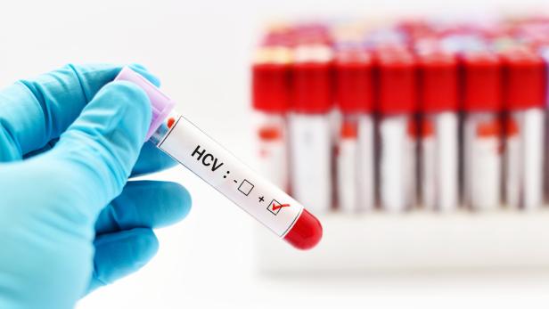Virusnachweis von Hepatits C (HCV) im Blut: Mehr als 95 Prozent leicht heilbar.