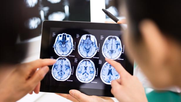 Parkinson-Prozesse beginnen im Gehirn zehn Jahre vor ersten Symptomen.