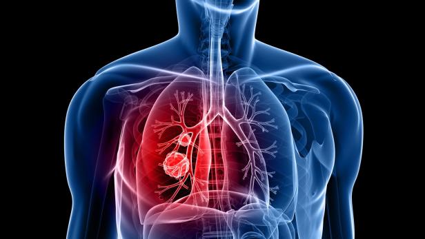Was die Diagnose Lungenkrebs heute bedeutet