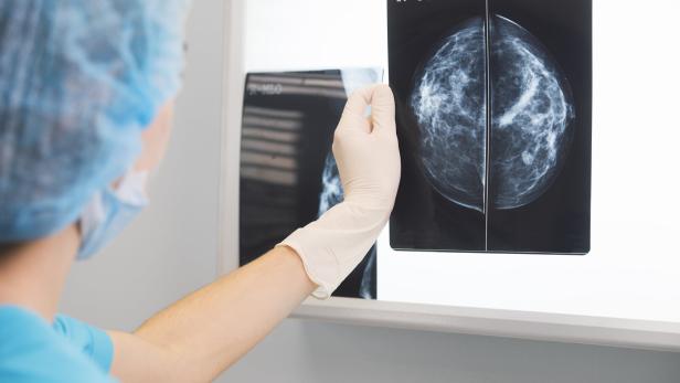 woman doctor or nurse in surgery outfit is holding a mammogram in front of x-ray illuminator
