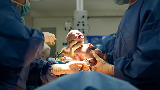Die Kaiserschnittrate nimmt weltweit zu. In Österreich erfolgt etwa jede dritte Geburt mittels Sectio.