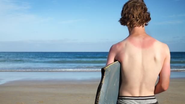 Wer zu lange ohne Hautschutz in der Sonne badet, kann rasch einen Sonnenbrand bekommen – die Haut ist rot, heiß, spannt und schält sich. Besonders gefährdet sind Schultern, Stirn, Ohren, Nase oder Waden.