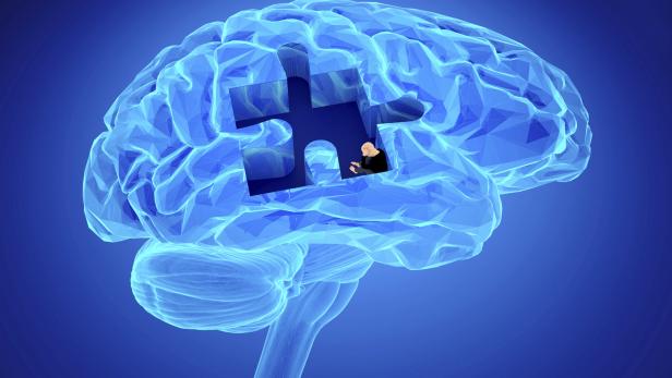 Erinnerung-Puzzlestein fehlt in menschlichem Gehirn und zeigt Alzheimer