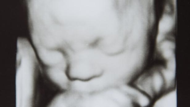 Pränataldiagnostik: Der Blick aufs Baby wird immer genauer