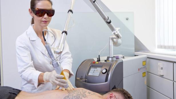 Tattooentfernung mit Laser bei Aestomed Wien
