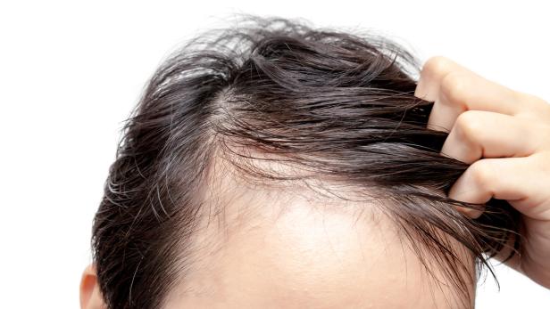 Forscher finden neuen Weg in der Behandlung von Haarausfall