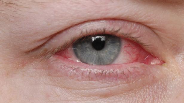 In Österreich berichten Augenärzte von steigenden Erkrankungsfällen an der sogenannten &quot;Augengrippe&quot;.