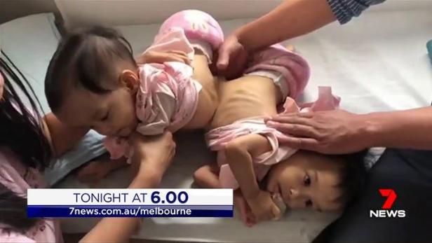 Siamesische Zwillinge werden in Spital in Melbourne getrennt