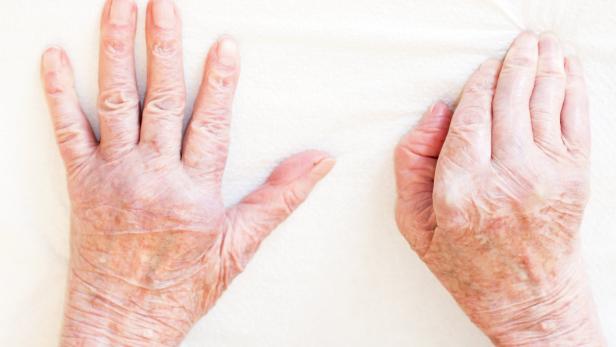 Rheumatoide Arthritis: 80 Prozent können ein normales Leben führen