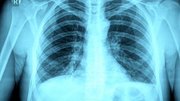 Chest X-ray image
