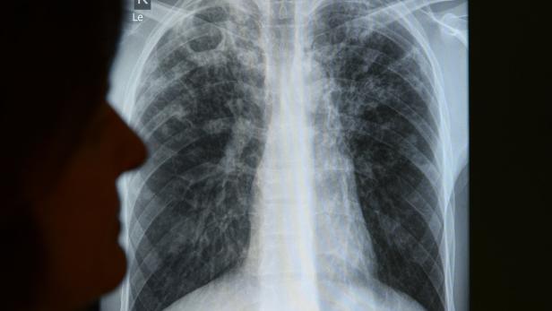 Die Infektionskrankheit Tuberkulose (TB) ist in Europa längst nicht ausgerottet.