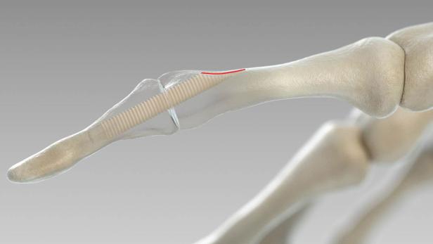 Grazer Forscher haben 2017 eine Alternative zur Behandlung von Knochenbrüchen entwickelt: chirurgische Schrauben aus Spenderknochen.