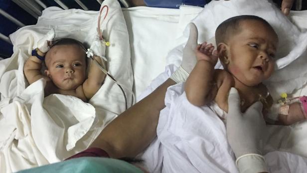 BANGLADESH-HEALTH-DOCTORS-CONJOINED-TWINS