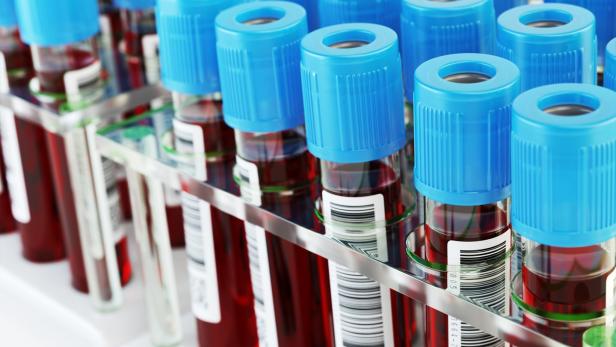 Coronavirus: Bei Blutgruppe A könnte das Risiko höher sein
