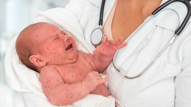 Doctor holding a newborn baby which is sick rubella or measles