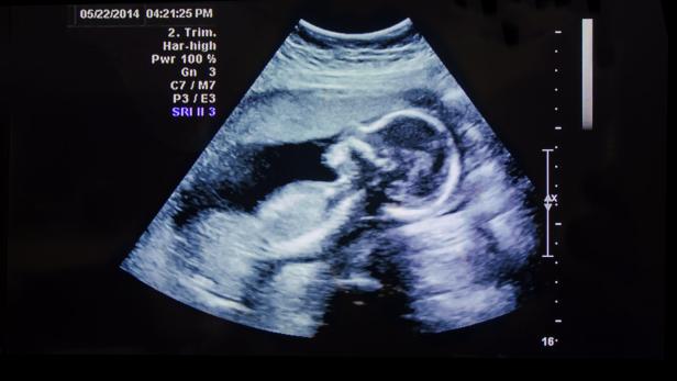 Infizierte Schwangere: Schadet Covid-19 der Plazenta?