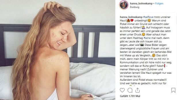 Ex-GNTM-Model: Hassnachrichten wegen Pickeln