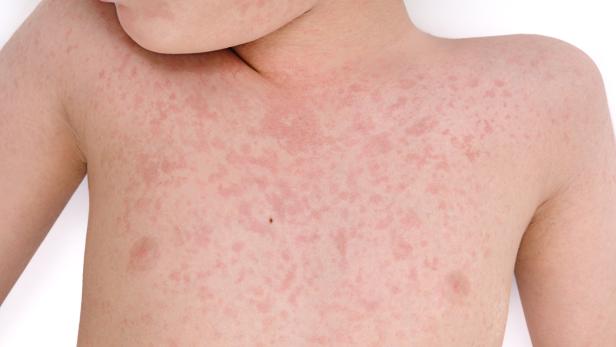 Urticaria on Body of a Child Isolated