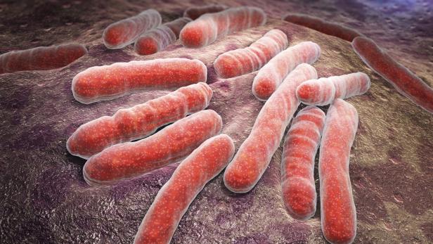 Notfall Sepsis: Meist kein "roter Strich" und lebesbedrohlich